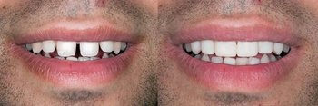 Smile Gallery - Ashton Dental, Aurora Dentist