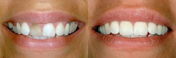 Smile Gallery - Ashton Dental, Aurora Dentist