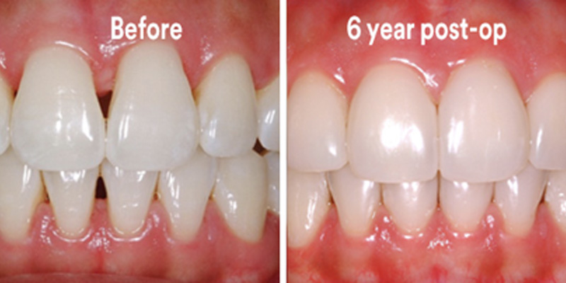 BioClear Diastema Closure and Black Triangle Closure  - Ashton Dental, Aurora Dentist