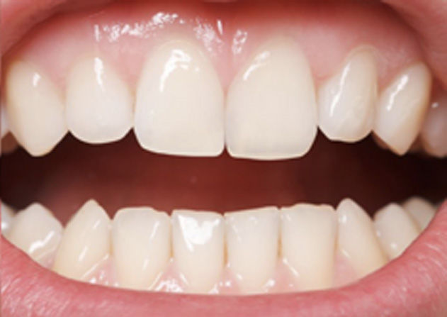 Cosmetic Bonding  - Ashton Dental, Aurora Dentist