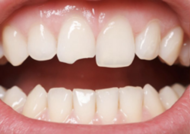 Cosmetic Bonding  - Ashton Dental, Aurora Dentist