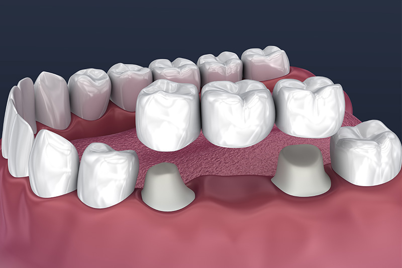 Crowns and Bridges, Inlays and Onlays  - Ashton Dental, Aurora Dentist