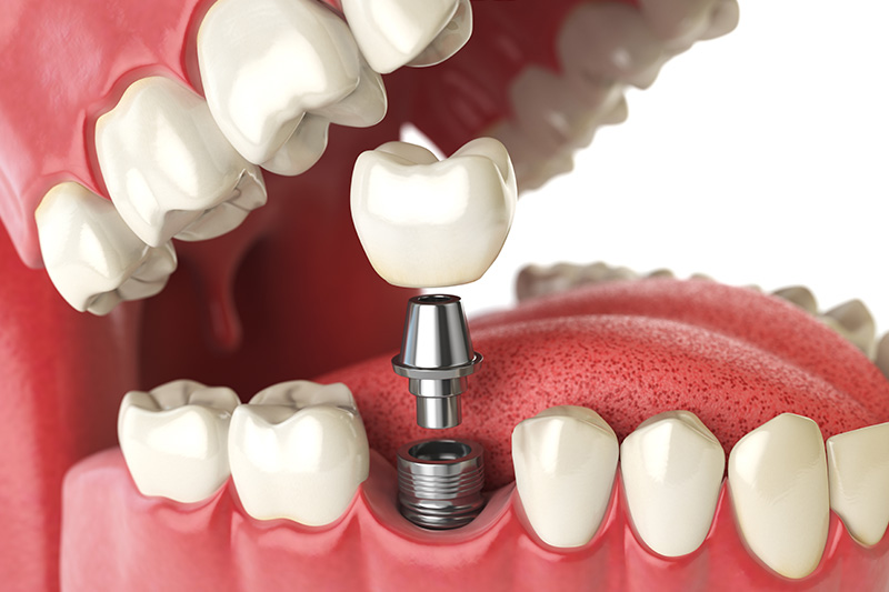 Dental Implants - Ashton Dental, Aurora Dentist