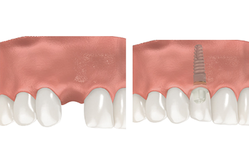 Dental Implants - Ashton Dental, Aurora Dentist