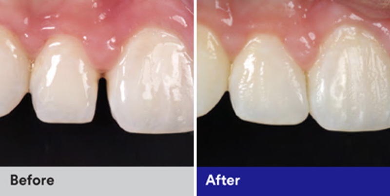 BioClear Diastema Closure and Black Triangle Closure  - Ashton Dental, Aurora Dentist