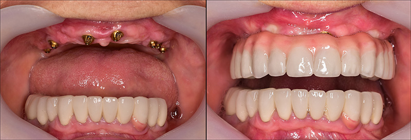 Implant Overdentures and Fixed All-On-X Treatment  - Ashton Dental, Aurora Dentist