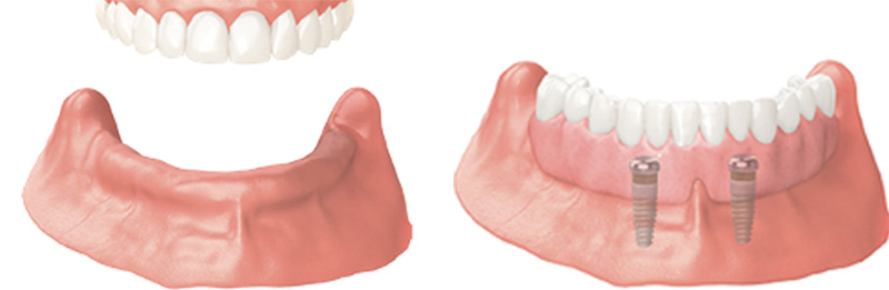 Implant Overdentures and Fixed All-On-X Treatment  - Ashton Dental, Aurora Dentist