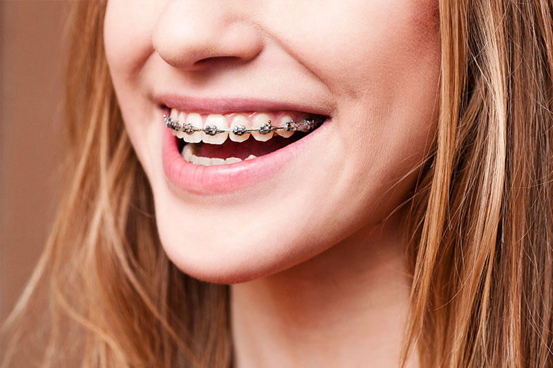 Orthodontics - Ashton Dental, Aurora Dentist