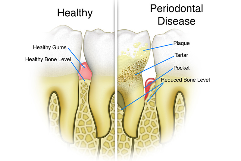 Scaling & Root Planings (Deep Cleanings)  - Ashton Dental, Aurora Dentist