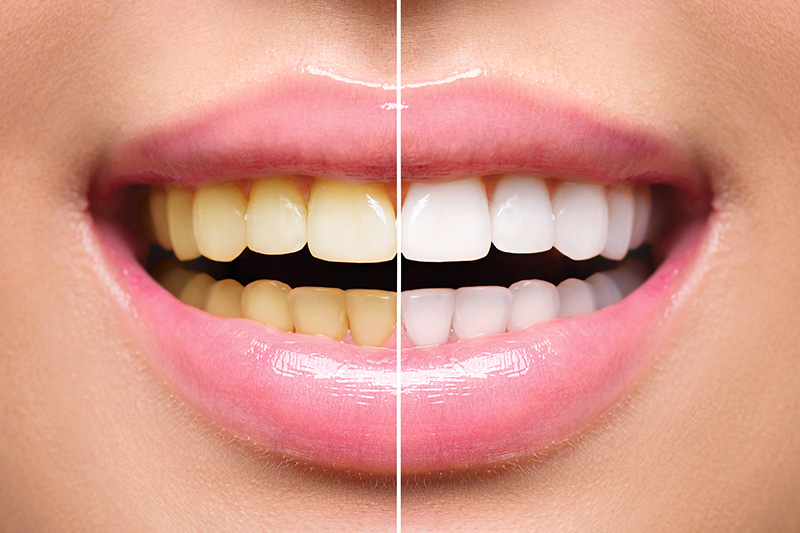 Teeth Whitening - Ashton Dental, Aurora Dentist