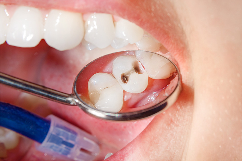 Tooth Colored Composite Fillings  - Ashton Dental, Aurora Dentist