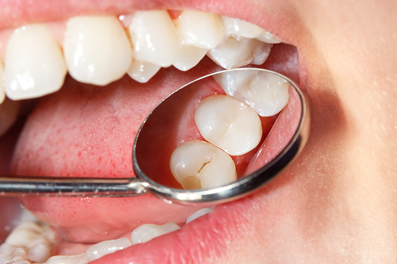 Tooth Colored Composite Fillings  - Ashton Dental, Aurora Dentist