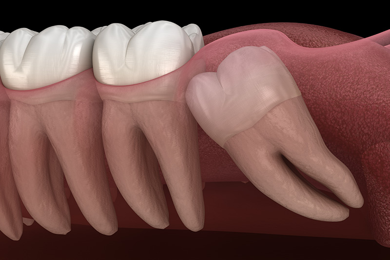 Wisdom Teeth Extractions (with Sedation)  - Ashton Dental, Aurora Dentist